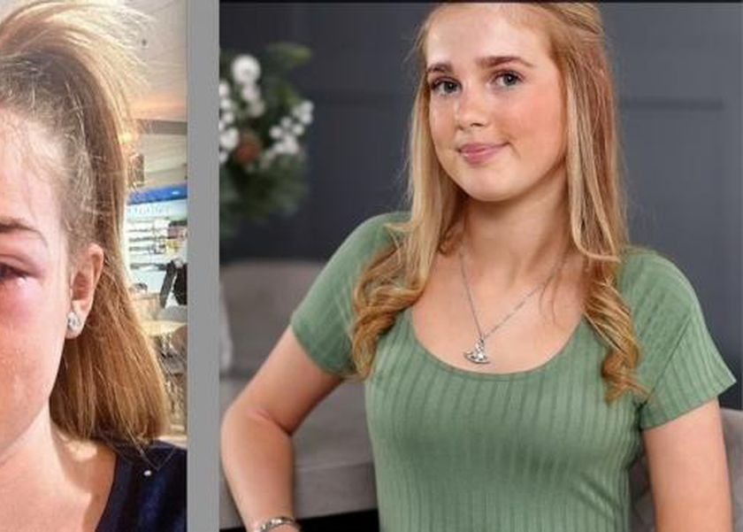 وصفة للبشرة على «تيك توك» هددت طفلة أمريكية بالعمى.. وطبيب يحذر من المخاطر