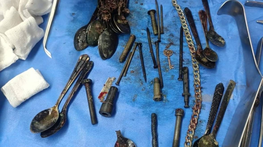 مستشفيات جامعة المنوفية تنقذ حياة مريض مصري ابتلع «أجساماً معدنية»