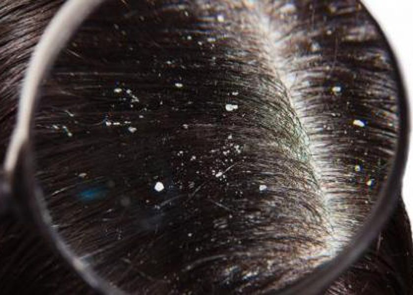 5 أطعمة لإنهاء معاناة قشرة الشعر.. طبيبة تقدم حلا سحريا