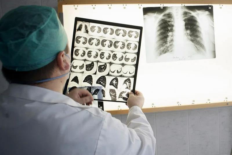 المغرب يطمح إلى تكثيف التدخلات من أجل مكافحة انتشار داء السل بالبلاد