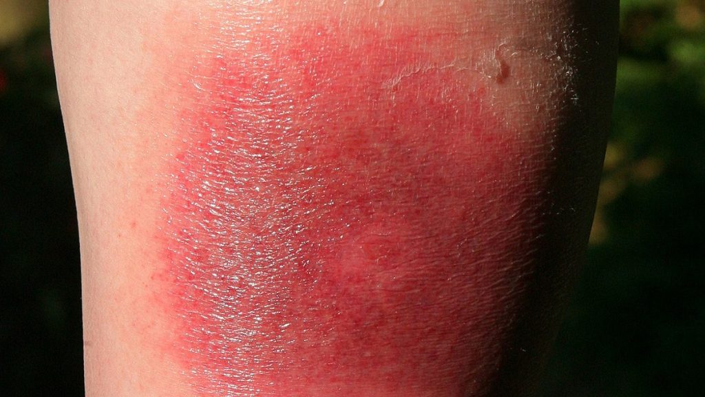 لدغة حشرة صغيرة تنتشر في الصيف قد تتسبب بمشكلة كبيرة