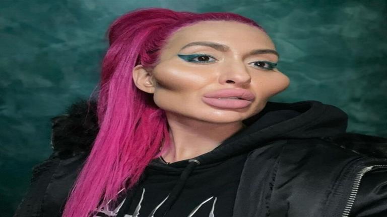 كيف كان وجه صاحبة “أكبر خدود في العالم” قبل التجميل؟ (صور)