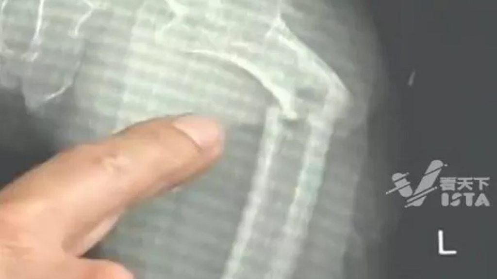 سعل فكسر أقوى عظمة في جسمه.. والسبب إدمان هذا المشروب الغازي