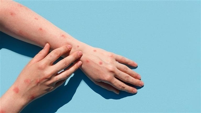 بعد تحذير الصحة العالمية.. أنواع جدري القرود – وهل تسبب الوفاة؟