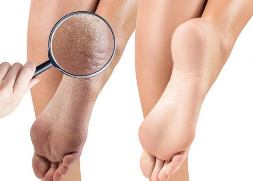 3 وصفات طبيعية تخلصك من تشقق القدمين بسهولة.. اتبعي هذه الخطوات