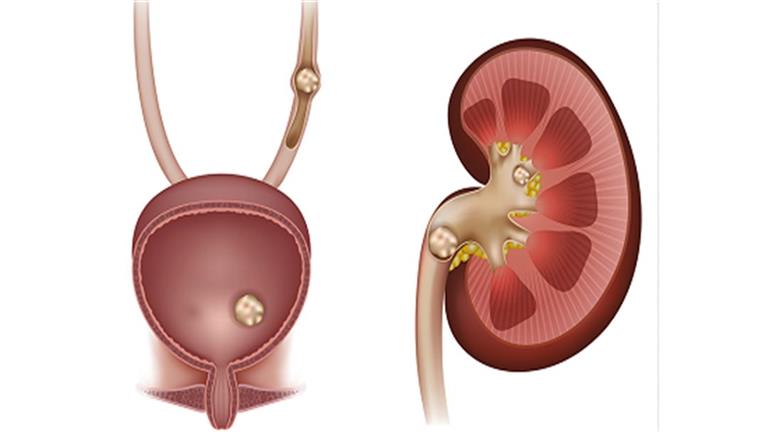 علاجات طبيعية تخلصك من حصوات الكلى