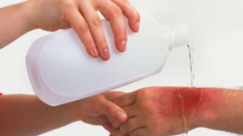 نصائح من «العليا للاستغاثات الطبية» حال التعرض للحروق.. إرشادات لكل نوع
