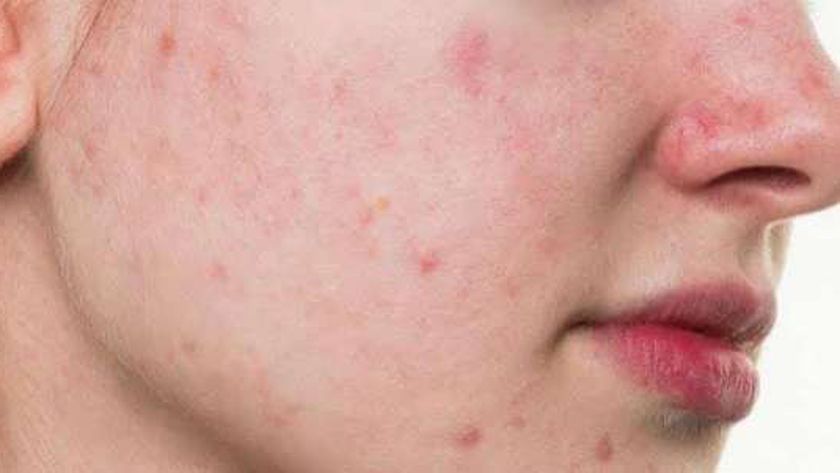 أسباب الإصابة بحب الشباب رغم انخفاض درجة الحرارة في الخريف والشتاء