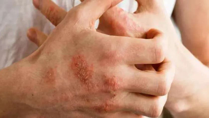 أخصائي أمراض جلدية: مرض الأكزيما ينتشر في الشتاء ويظهر بمنطقة الرقبة