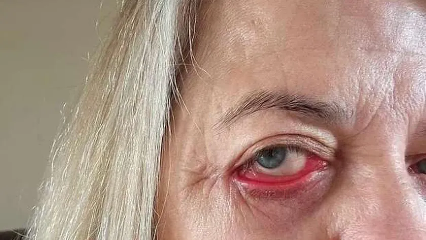 هدية عيد ميلاد تنقلب إلى مأساة.. تجربة مؤلمة لأم بعد عملية تجميل العين