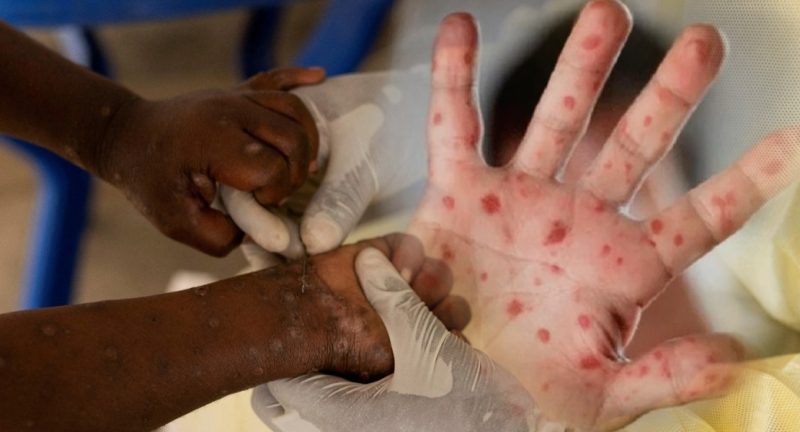 جدري القردة يصيب أزيد من 46 ألف شخص في أنحاء إفريقيا ومنظمة صحة تؤكده حالة طوارئ صحية