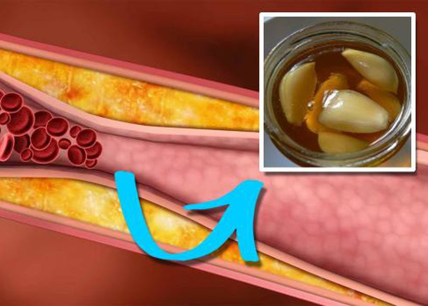 أسباب ارتفاع نسبة الدهون في الدم.. كيف تحمي نفسك من مخاطرها؟