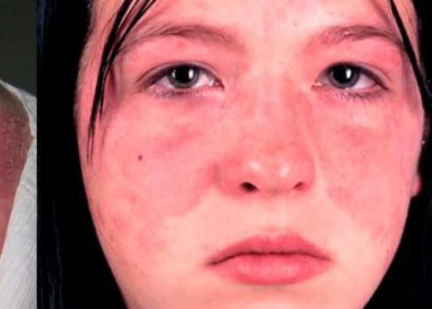 ما مرض الذئبة وطرق علاجه؟.. يؤثر على القلب ويسبب فقدان الذاكرة