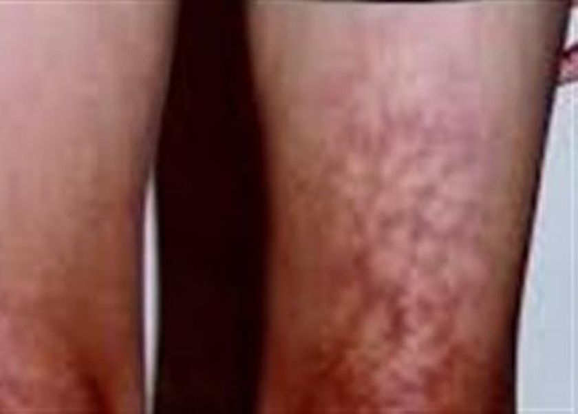 تحذير من استخدام اللاب توب بهذه الطريقة.. تسبب متلازمة الجلد المحمص