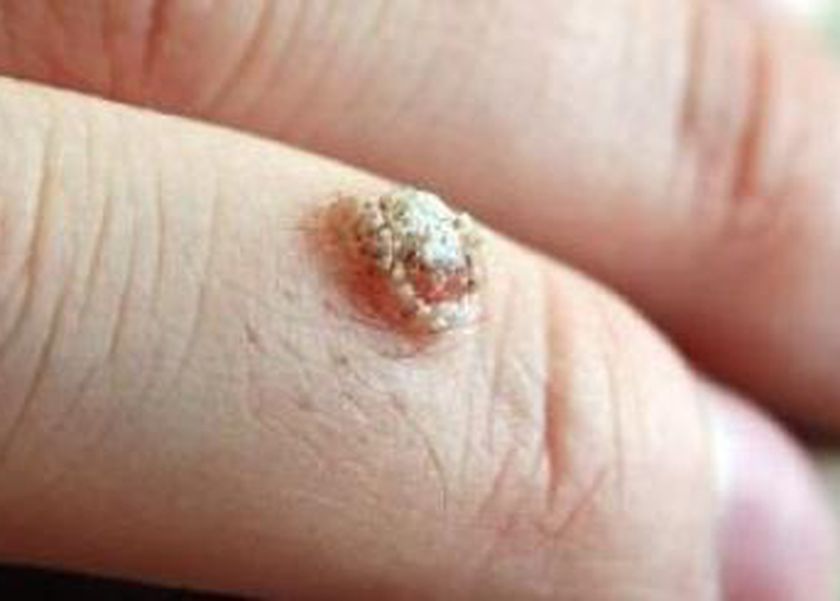 السنط الجلدي وخطورته على النساء.. هل يصل لسرطان عنق الرحم؟