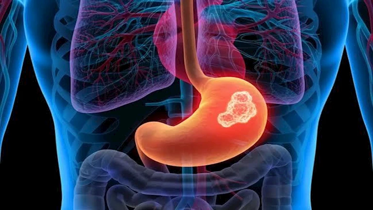 5 علامات صامتة لسرطان المعدة.. لا تتجاهلها