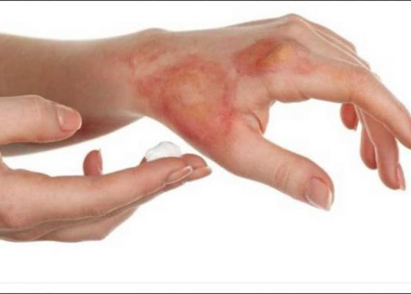 ماذا تفعل إذا تعرضت لحروق من الدرجة الأولى؟.. إليك الحل الأمثل