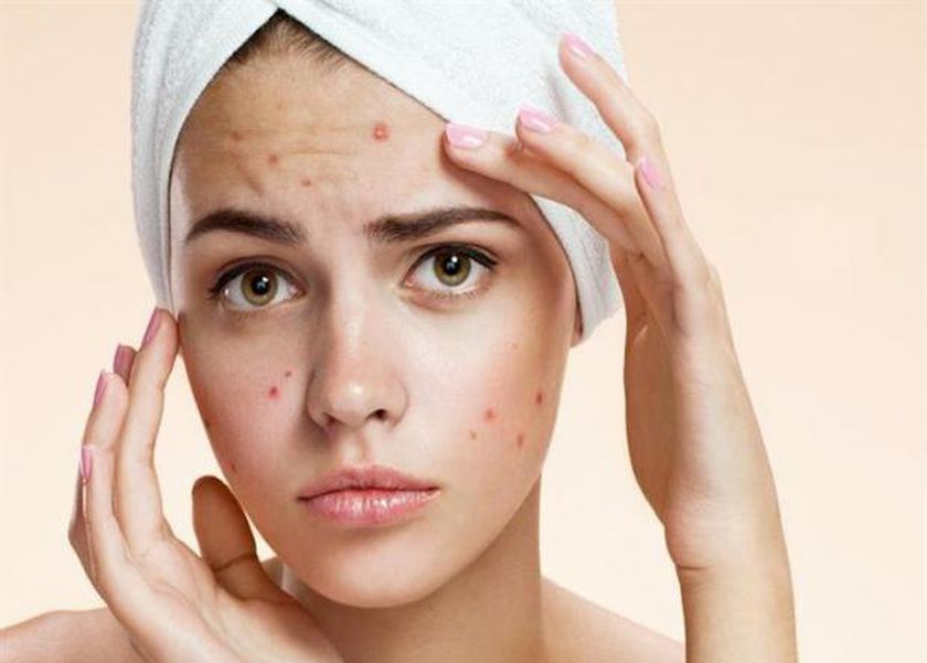 5 طرق طبيعية لتجفيف حبوب الوجه دون آثار.. «رطبي بشرتك»