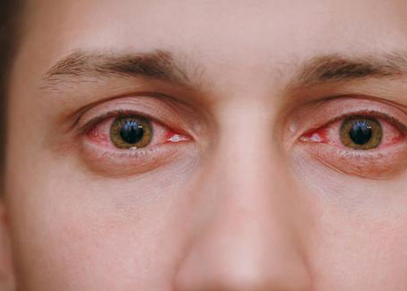 الرمد الربيعي.. كل ما تحتاج معرفته عن الأعراض والعلاج وطرق الوقاية