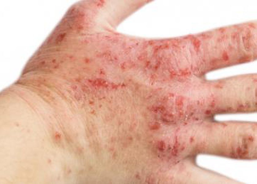 هل يوجد علاج نهائي للإكزيما؟.. 4 طرق للسيطرة عليها وتخفيف آثارها