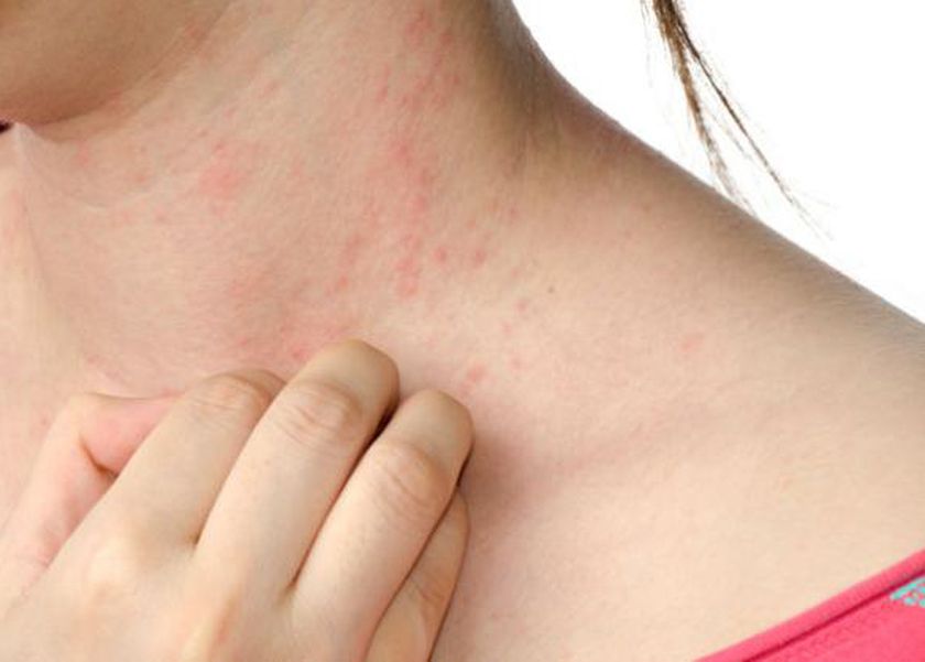 احمِ بشرتك من حساسية الجلد.. خطوات بسيطة تحميك من عدو الصيف الصامت