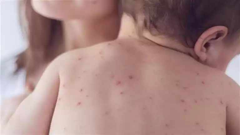 لأول مرة منذ 35 عامًا.. تفشي مرض الحصبة بولاية أمريكية