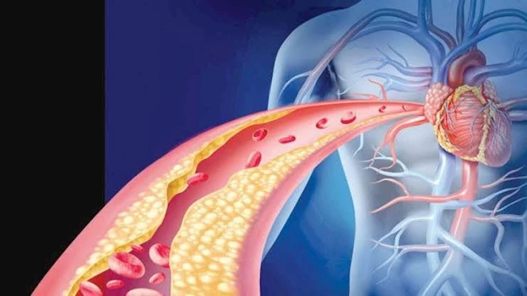 كيف تؤثر مستويات الكوليسترول على الدماغ؟