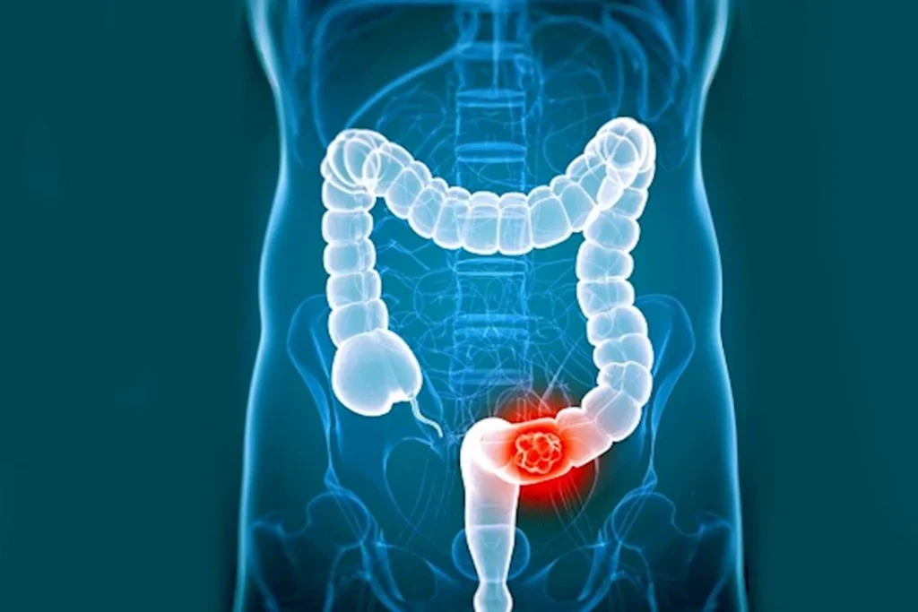 السبب الأول لسرطان القولون.. توقف عن تناول هذا الطعام فورا