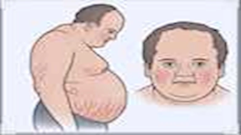 عانى منها ابن أغنى رجل في آسيا.. ما هي متلازمة كوشينغ؟