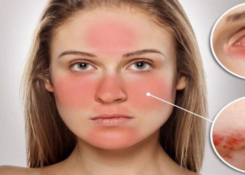 الذئبة الحمراء.. مرض صامت يقضي على الجسد من الداخل