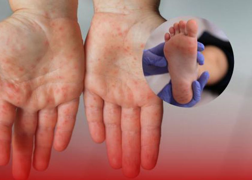 عاجل: عدوى منتشرة تشبه الجدري وترعب الأمهات.. تعرف على فيروس كوكساكي