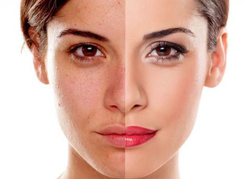 طرق فعالة لحماية البشرة من التصبغات الشمسية والبقع الجلدية في الصيف