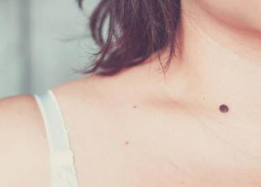 إصابة لاعبة كمال أجسام بسرطان قاتل.. احذر ظهور شامة غريبة