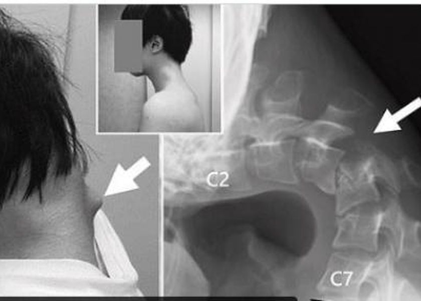 فقد القدرة على رفع رأسه.. شاب يتعرض لإصابة مرعبة بسبب لعبة إليكترونية