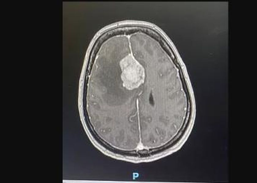 علامات شائعة تشير إلى الإصابة بورم خطير في الدماغ