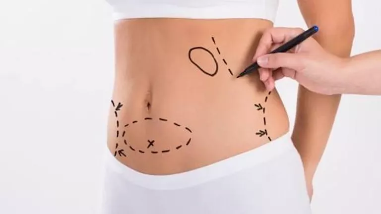 احذر .. اضرار شفط الدهون بكميات كبيرة من الجسم