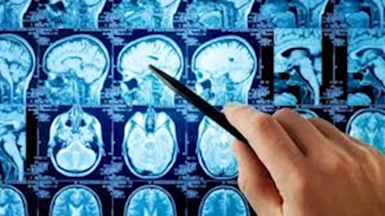 اختبار جديد يسرع تشخيص أورام الدماغ في ساعتين بدلا من 8 أسابيع