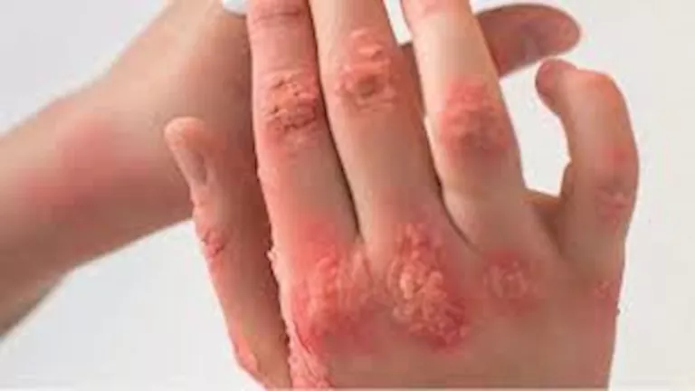 يجمد الجسد.. فيروس “غرب النيل” يصل بريطانيا لأول مرة