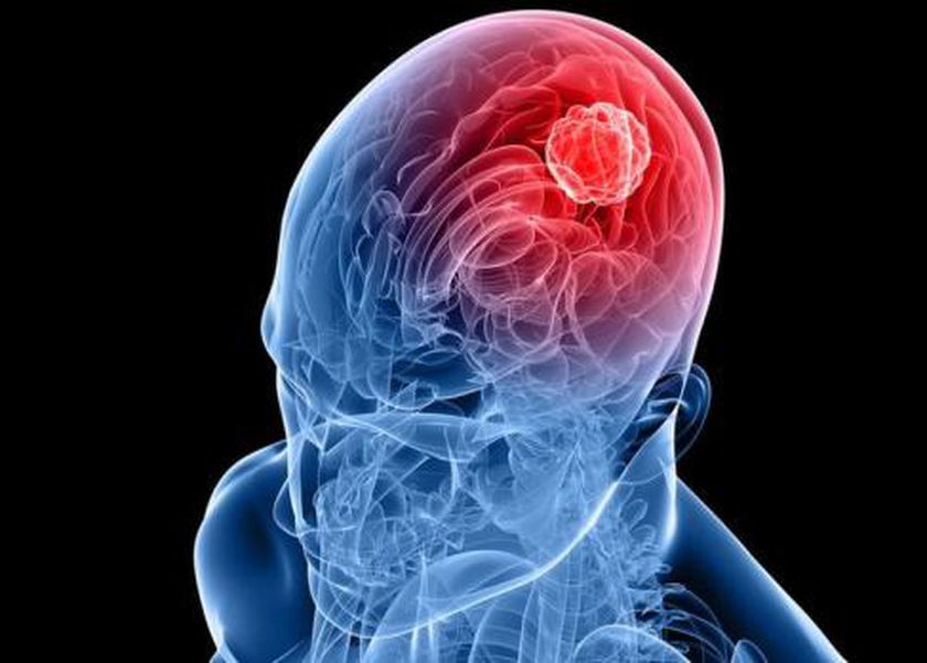 مرض عدواني يهاجم الدماغ بشراسة ويتحدى العلاج.. معلومات عن الورم الأورومي الدبقي