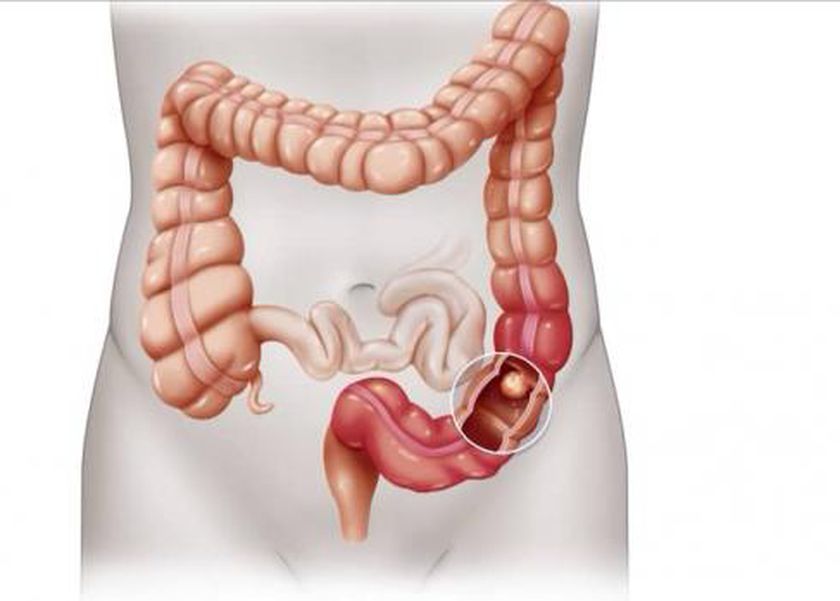عادة يومية تقلل معدلات الوفاة بسرطان القولون.. و7 أعراض تثير القلق