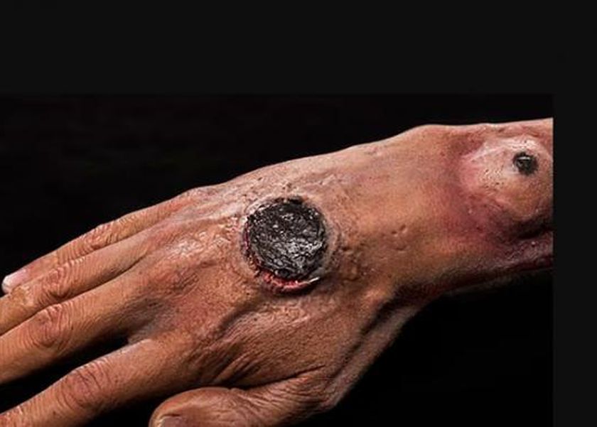 بعد وفاة شخص في تايلاند.. ما مرض الجمرة الخبيثة القاتل؟