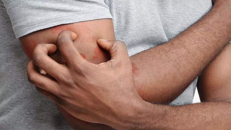 احذر.. الحكة بعد الاستحمام قد تشير إلى أمراض خطيرة