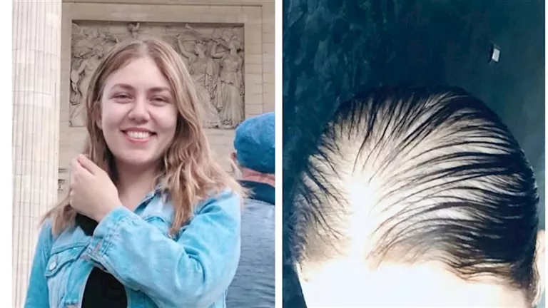 بعد صدمة رحمة حسن مع الصلع.. 4 حلول طبيعية لاستعادة كثافة الشعر