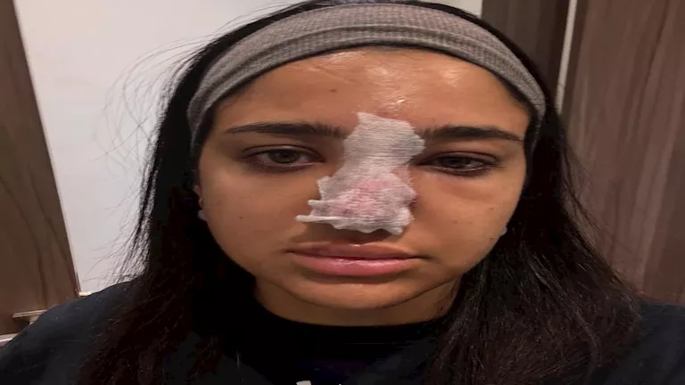 “مناخيري كانت هتروح”.. كنزي مدبولي تكشف معاناتها مع حقنة الفيلر