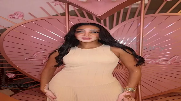 خطفت الأنظار في إيطاليا.. من هي أول ملكة جمال مصرية مصابة بالبهاق؟